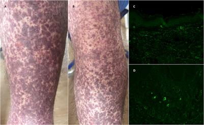 Cutaneous vasculitis: Lessons from COVID-19 and COVID-19 vaccination